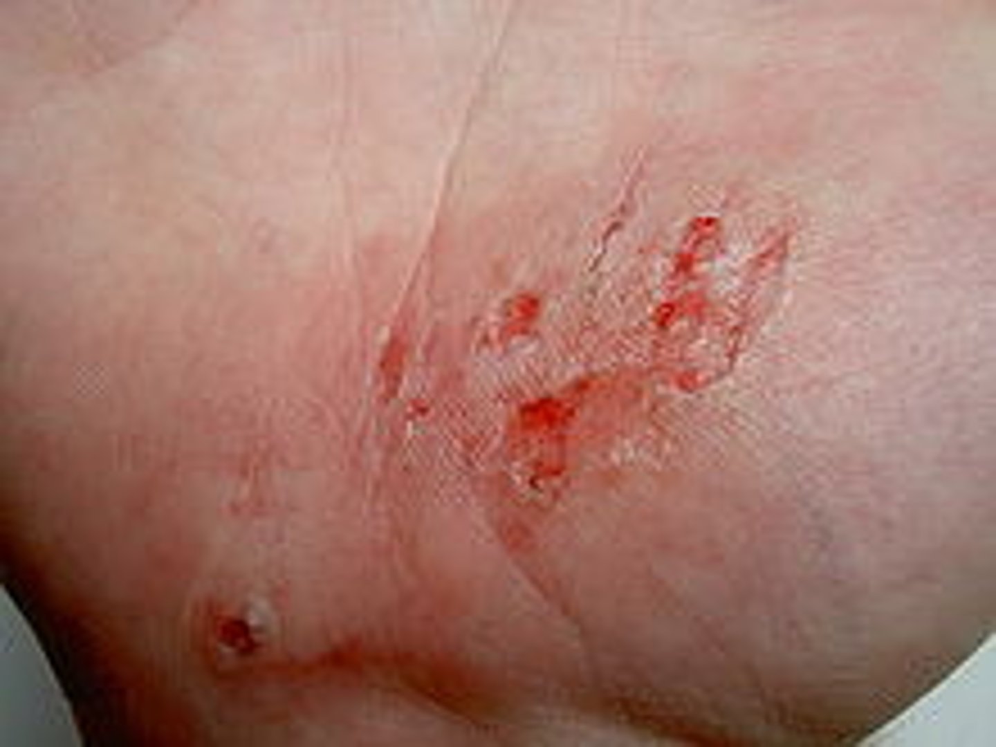 <p>most common type of open wound which is characterized by skin that has been rubbed or scraped away</p>