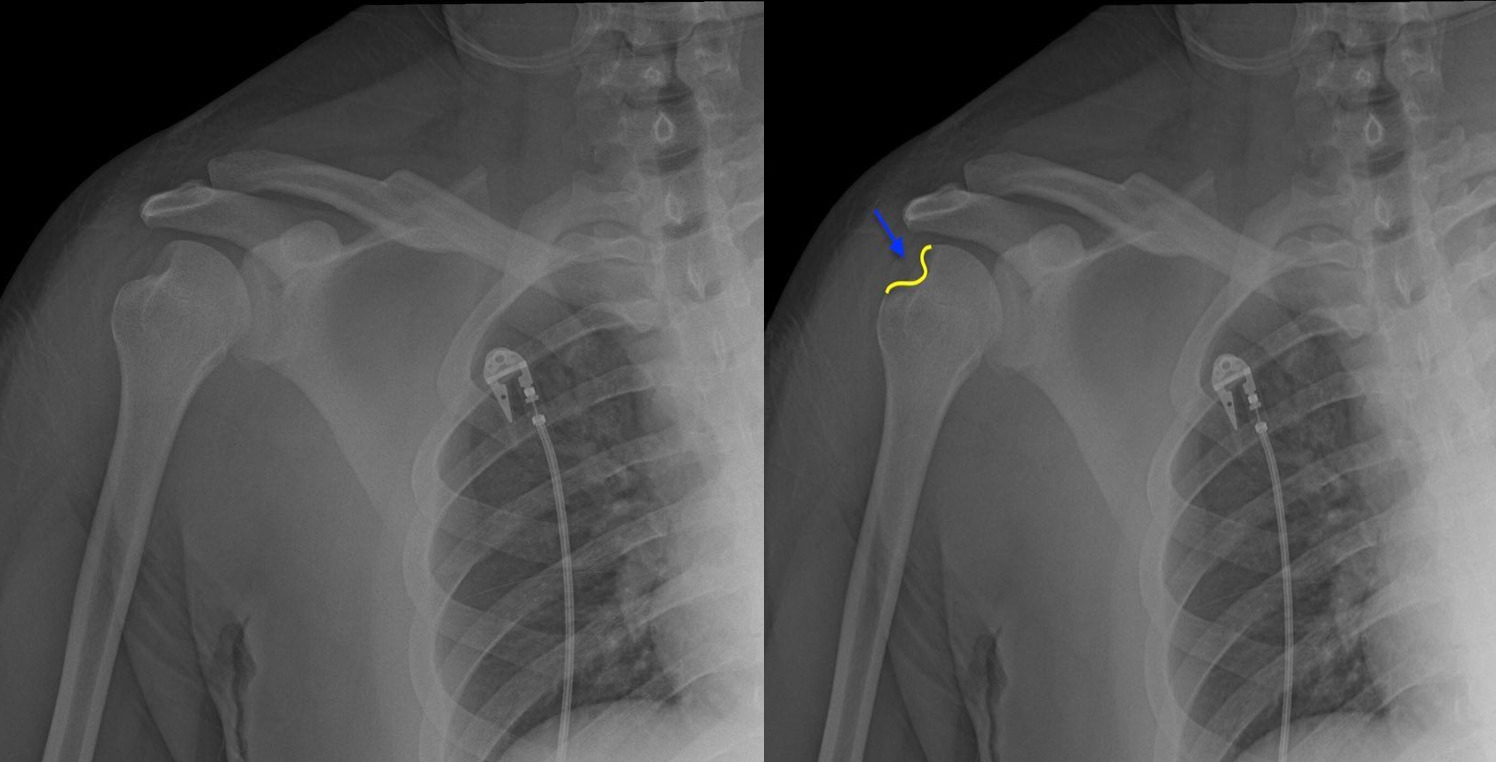 <p>What deformity is shown in this xray?</p>
