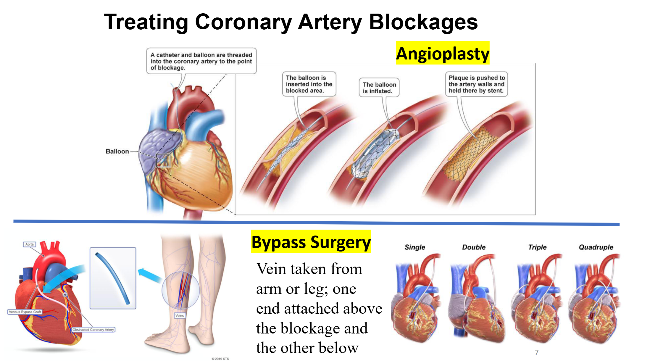 <ul><li><p><strong>Angioplasty </strong>→ <span><span>Insertion of a balloon into a blocked area</span></span></p></li><li><p><span><span>B</span></span>alloon is subsequently inflated, and the inflation of this balloon then pushes plaque to the artery walls.</p></li><li><p>A stent is placed in order to keep that plaque pushed up against those walls.</p></li><li><p><strong>Bypass Surgery</strong> → <span><span>Vein taken from arm or leg; one end attached above the blockage and the other below</span></span></p></li><li><p><span style="background-color: transparent;"><span>Single, double, triple, or quadruple bypasses are possible </span></span></p></li></ul><p></p>