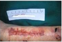 <p>Skin Tears: Category I Linear type/Flap Type </p>