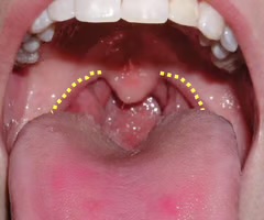 <p>related to the tonsils</p>