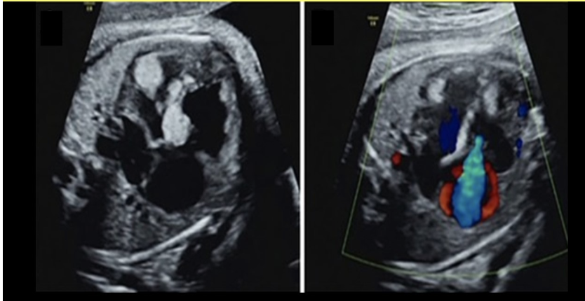 <p>the most <strong>common</strong> intra<strong>cardiac mass</strong> seen in fetus is</p><p>a) myxoma</p><p>b) fibroelastoma</p><p>c) rhabdomyoma</p><p>d) sarcoma</p>