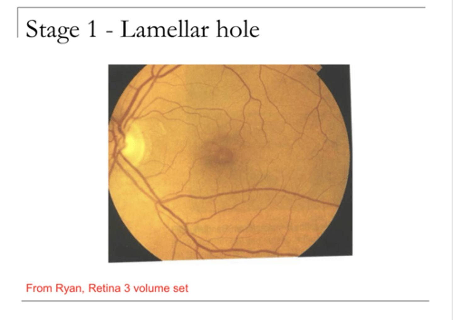<p>Describe Lamellar Hole</p>