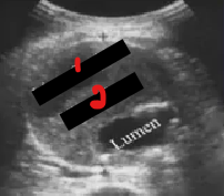 <p>Label the crossed-out structures on the image. </p><ol start="3"><li><p>What pathology is this? </p></li></ol><p></p>