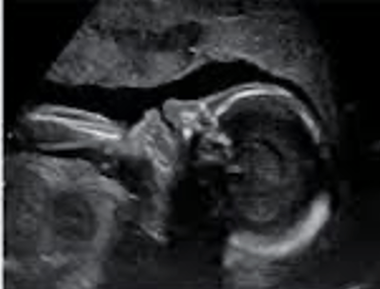 <p>Absent nasal bone</p><p>Common with Trisomy 21</p>