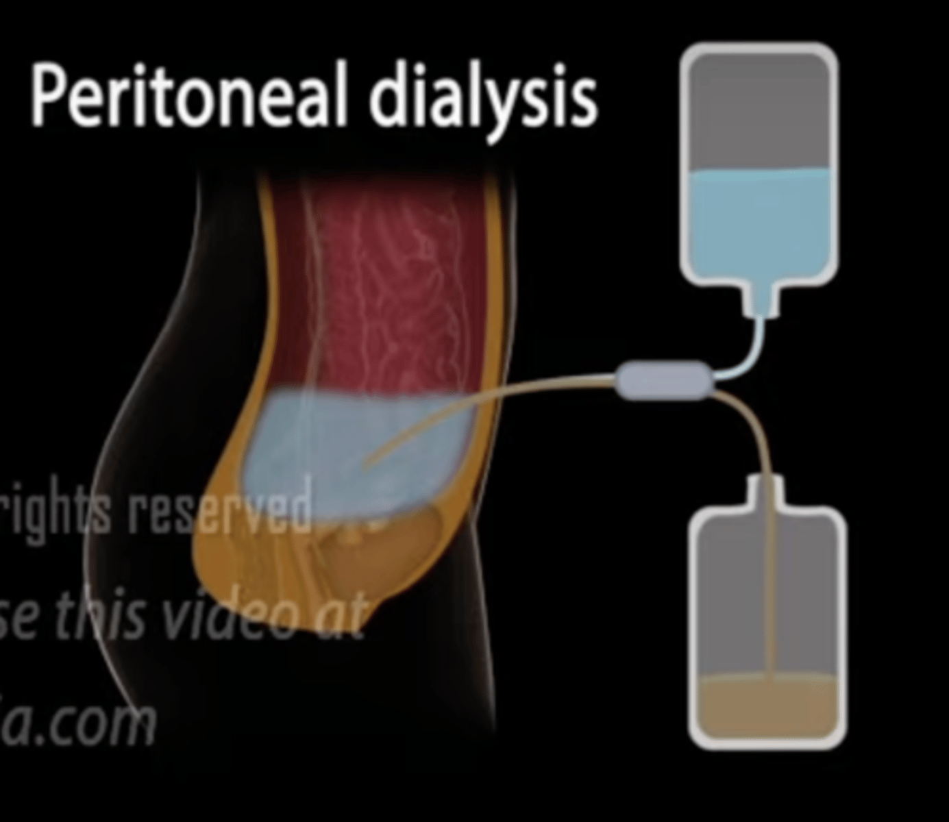 <p>1. haemodialysis</p><p>- 4 hours 3 times a week come into hospital (significant impact on quality of life)</p><p>- fistula (unsightly)</p><p>side effects: itchy skin, fatigue, swelling</p><p>2. peritoneal dialysis</p><p>how it works: give fluid into tummy. There is a lining around your organs called the peritoneum. Blood gets filtered through the lining of the peritoneum and into the fluid. The waste fluid is then drained. The cycle is repeated.</p><p>- infection (peritonitis)</p><p>- need to do it your self</p><p>- weight gain</p><p>- blood sugar variation</p><p>3. renal replacement therapy</p><p>- risk of rejection</p><p>- need to find a donor, average wait is 3y</p><p>- average lifespan of a kidney is 10-15 years</p>