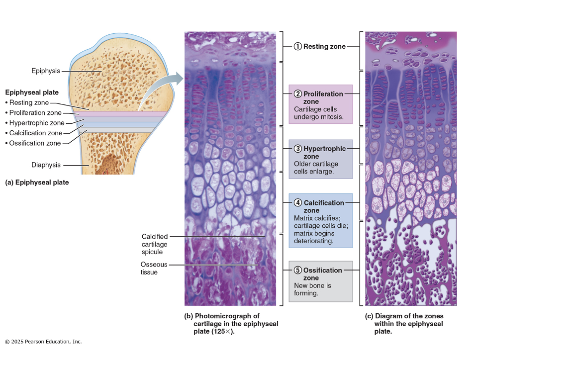 <p><span><span>- As the long bone lengthens, the shape of the ends must be altered</span></span><br><span><span>- Growing bones widen as they lengthen through appositional growth</span></span><br><span><span>- As the length increases, external surfaces of the ends made slimmer while the internal surface made thicker</span></span><br><span><span>- Bone is destroyed by osteoclasts and laid down by osteoblasts on both the inner and outer surfaces of a growing long bone</span></span></p>