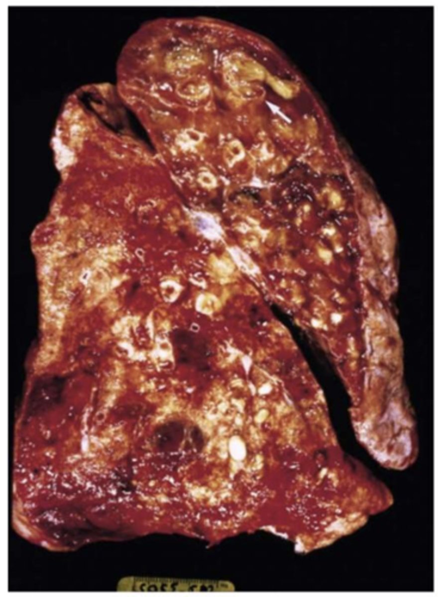 <p>Bronchiectasis</p>