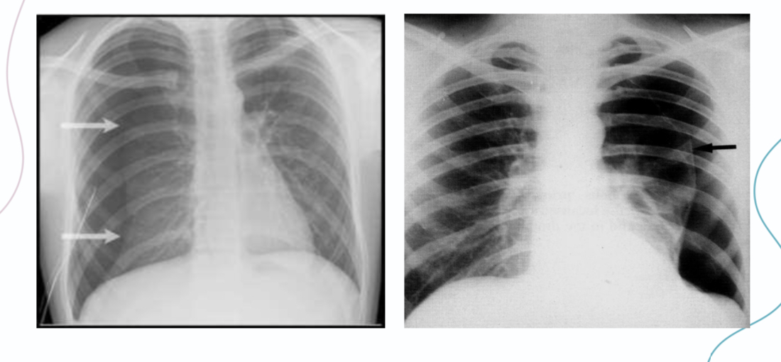 <p>1- absent lung markings</p><p>2- hyperlucent hemithorax (jet black) </p><p>3- presence of pleural line; <span>The presence of a</span></p><p><span>pneumothorax is established by demonstrating a</span></p><p><span>white visceral pleural line on the chest radiograph.</span></p>