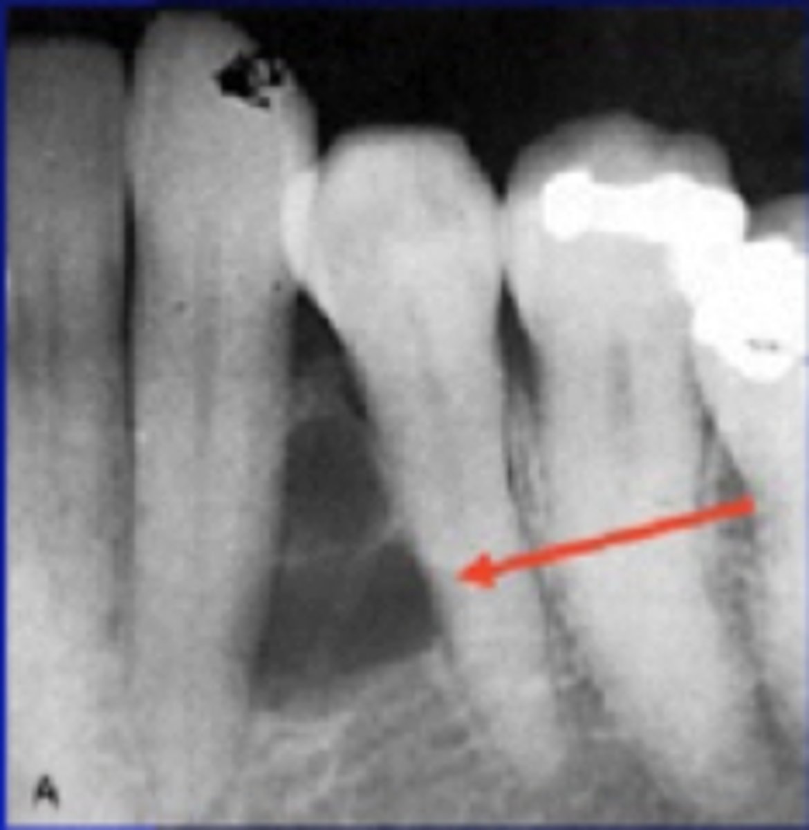 <p>-lateral periodontal cyst</p><p>-periapical granuloma or cyst along lateral canal</p><p>-anything else (esp odontogenic keratocyst)</p>