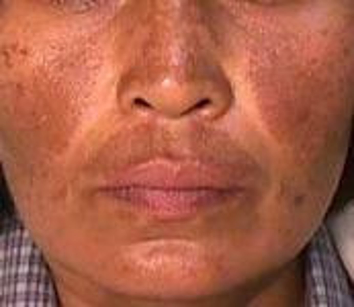 <p>hyperpigmentation of cheeks, nose, and forehead</p>