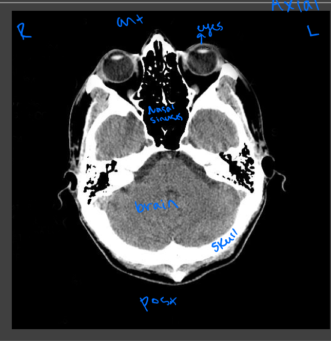 <p>Evaluating traumatic injury or to rule out bleeding or fracture, intercranial bleeds</p>