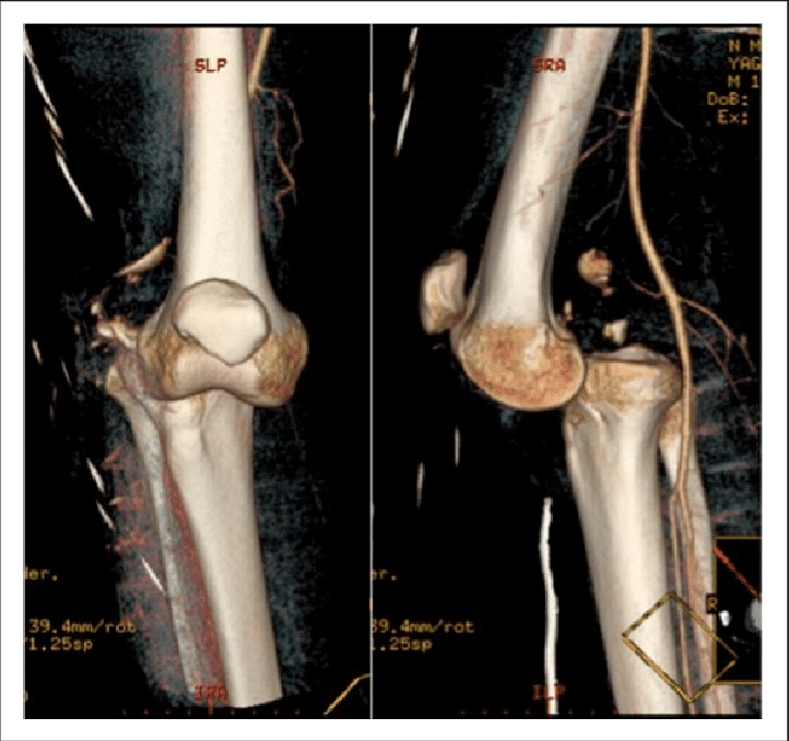 displacement of a bone from its joint. only happens to synovial joints (GH or fingers, usually due to hyperextension)
