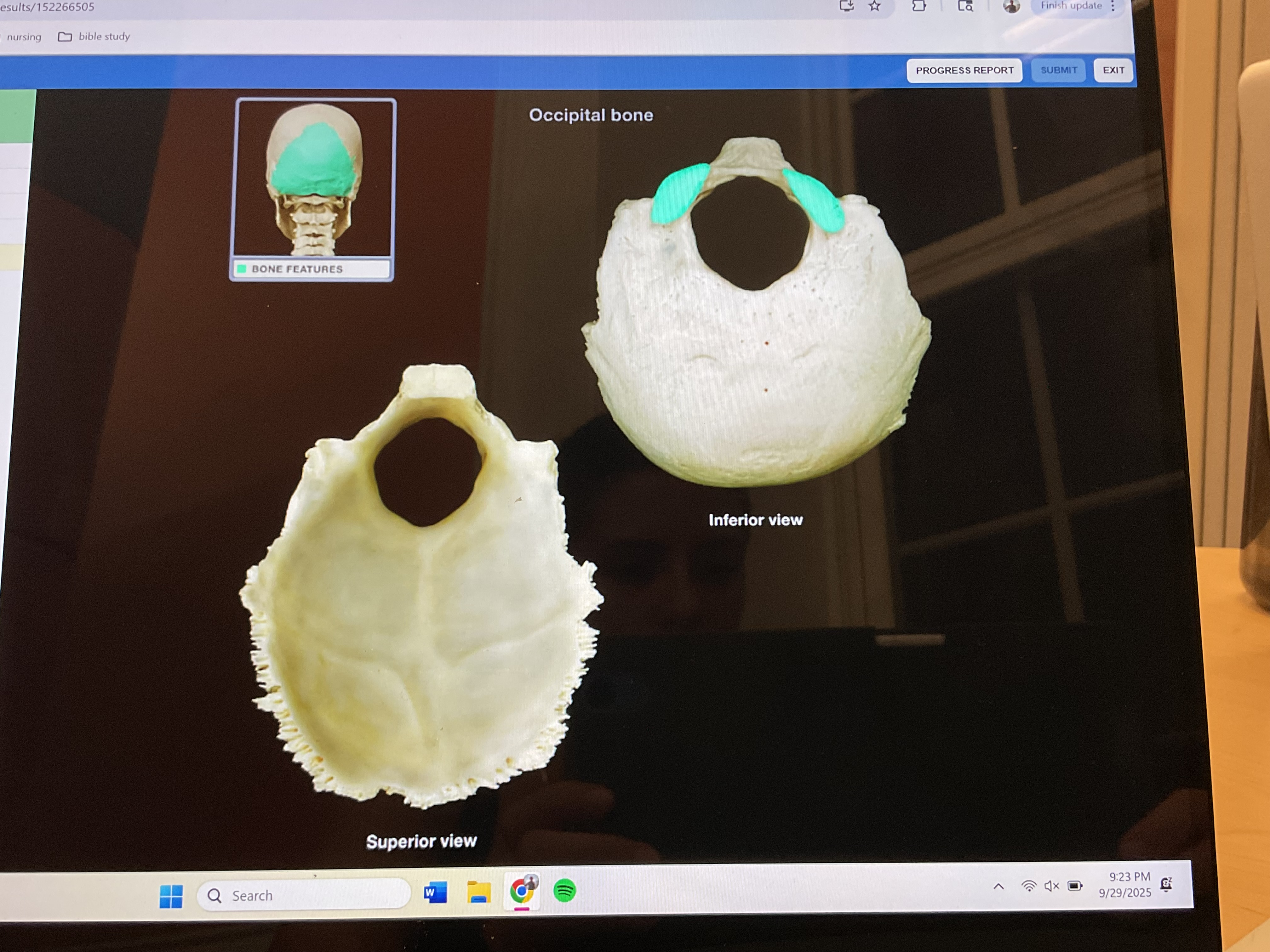<p>Occipital condyle </p>
