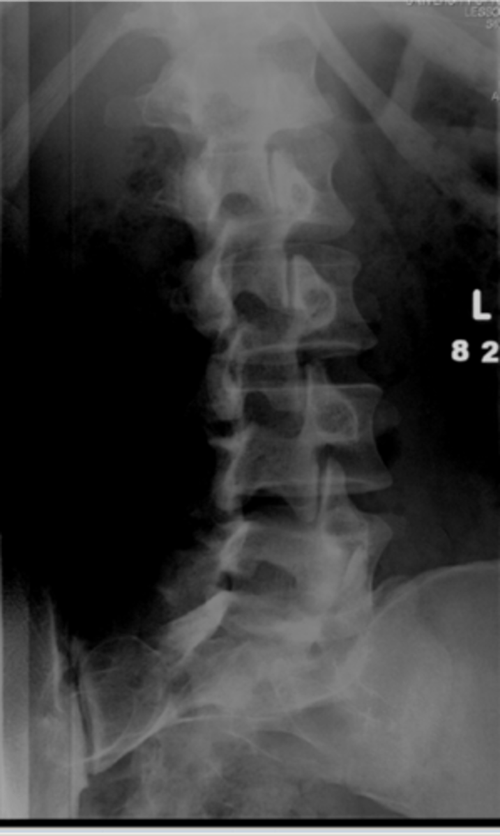 <p>Zygapophyseal joints = facet joint</p><p>ear of the lower Scotty Dog (superior articular facet) and the front paw of the upper dog (Inferior articular facet)</p><p>** Top Dawg Steps on Little Dawg</p>