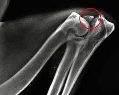 <p>This is an united anconeal process</p>