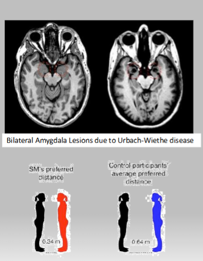 <p><span style="color: #fbfbfb">• Patient “S.M.”; Urbach-Wiethe disease, destroyed amygdala bilaterally</span></p><p><span style="color: #fbfbfb"><br></span><span>• </span><span style="color: #fbfbfb">Physically unable to feel fear- will approach spiders and snakes</span></p><p><span style="color: #fbfbfb"><br></span><span style="color: #fbfbfb">• Cannot recognize fear in facial expressions</span></p><p><span style="color: #fbfbfb"><br></span><span style="color: #fbfbfb">• Does not have a concept of personal space</span></p><p><span style="color: #fbfbfb"><br></span><span style="color: #fbfbfb">• Does have startle response that does not depend on the amygdala</span></p><p><span style="color: #fbfbfb"><br></span><span style="color: #fbfbfb">• Can follow group fear responses due to voices and body responses in others</span></p><p><span style="color: #fbfbfb"><br></span><span style="color: #fbfbfb">• Has survived physical abuse and had a knife held to her throat</span></p>