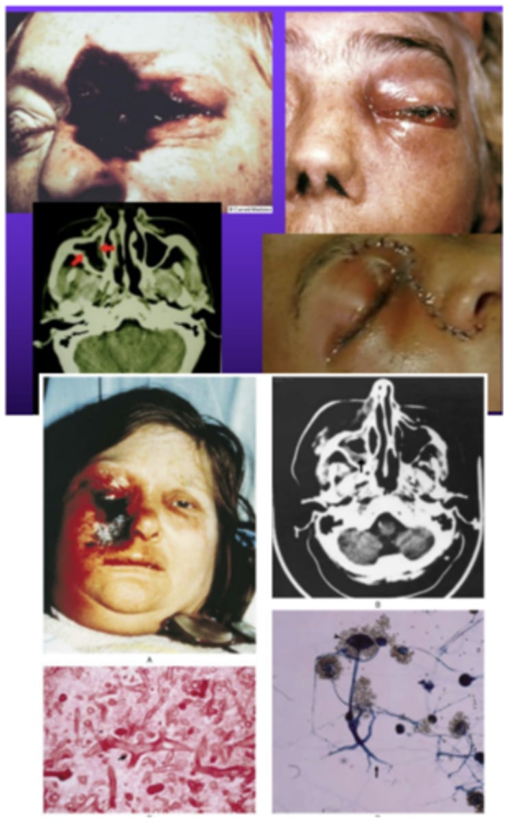 <p>rhinocerebral mucormycosis</p>