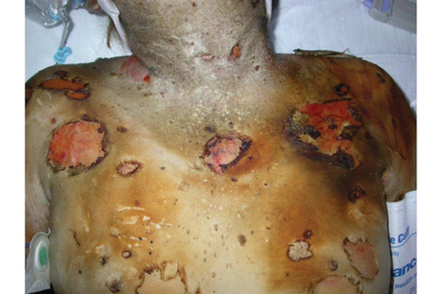 <p>burns through all layers of skin to the subcutaneous tissues</p><p>skin is white, brown, or black. no blisters. leathery or waxy and is painless. cap refill does not blanch.</p>