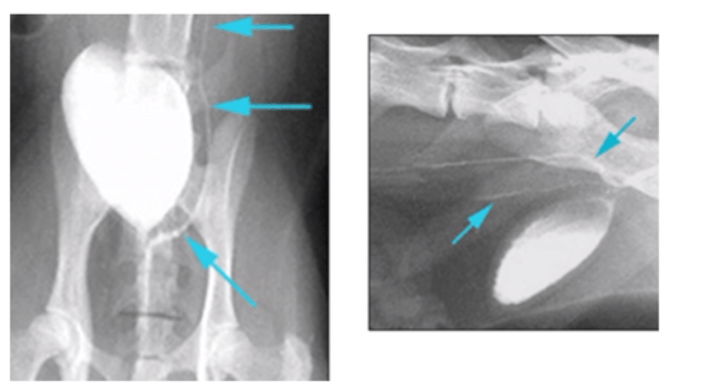 <p>Wat is een ectope ureter? (ooraak hydronefrose)</p>