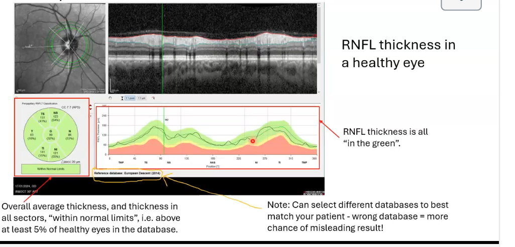 <p>above at least 5% of healthy eyes in the database </p>