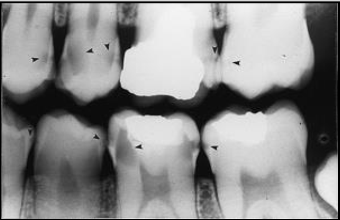 <p>Rampant caries refers to growing or spreading caries. </p><ul><li><p>Advanced and severe affecting numerous teeth (can happen to both primary and permanent dentition)</p></li><li><p>Happens in children with poor dietary habits, nursing bottle syndrome or in adults with xerostomia (dry mouth) due to mediations.</p></li><li><p>Can also be a secondary condition to chemo radiation therapy&nbsp;</p></li></ul><p></p>