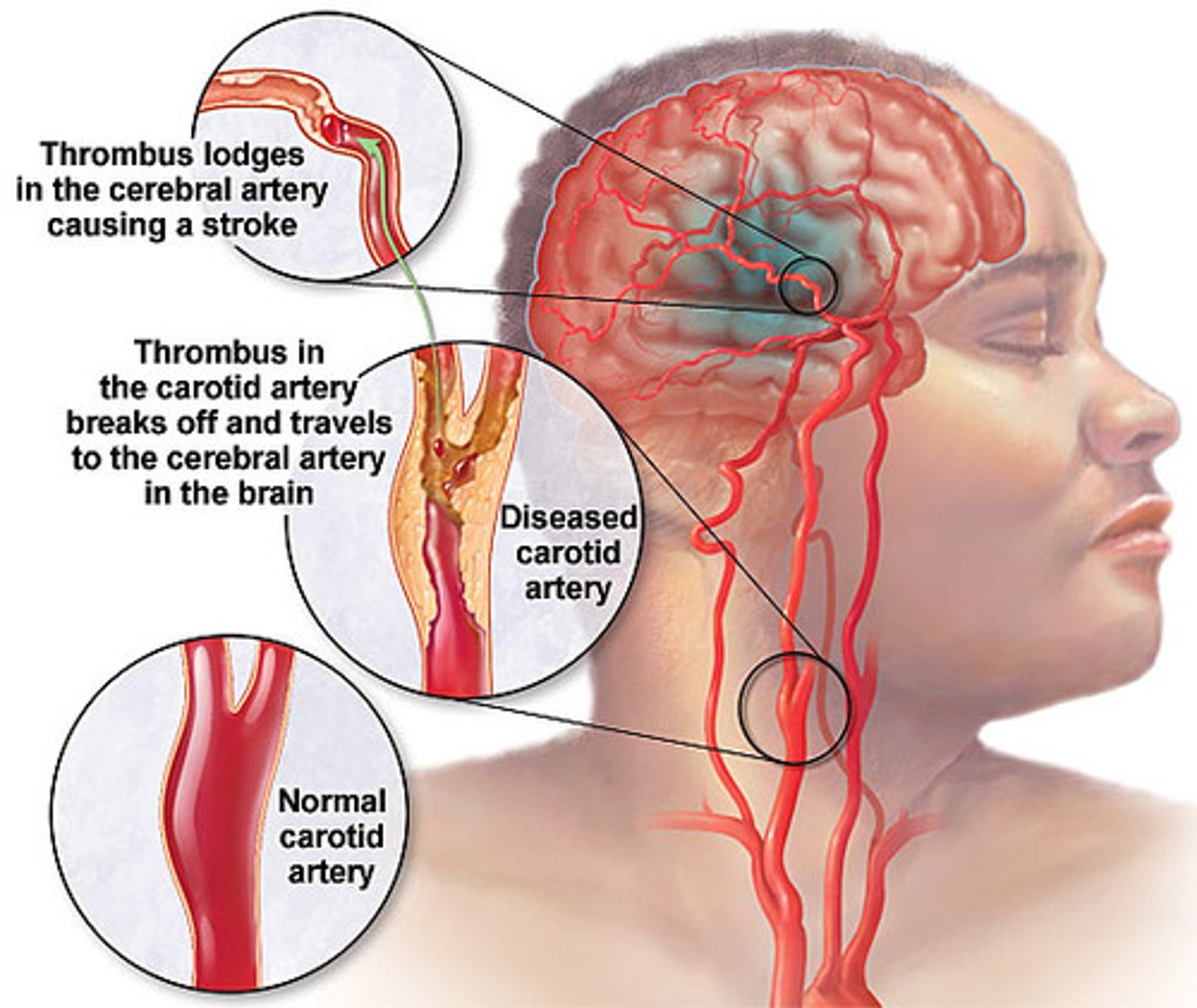 <p>Stroke; The sudden death of some brain cells due to lack of oxygen when the blood flow to the brain is impaired by blockage or rupture of an artery to the brain</p>