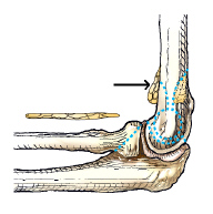 Which fat pad is identified by the arrow in this figure?