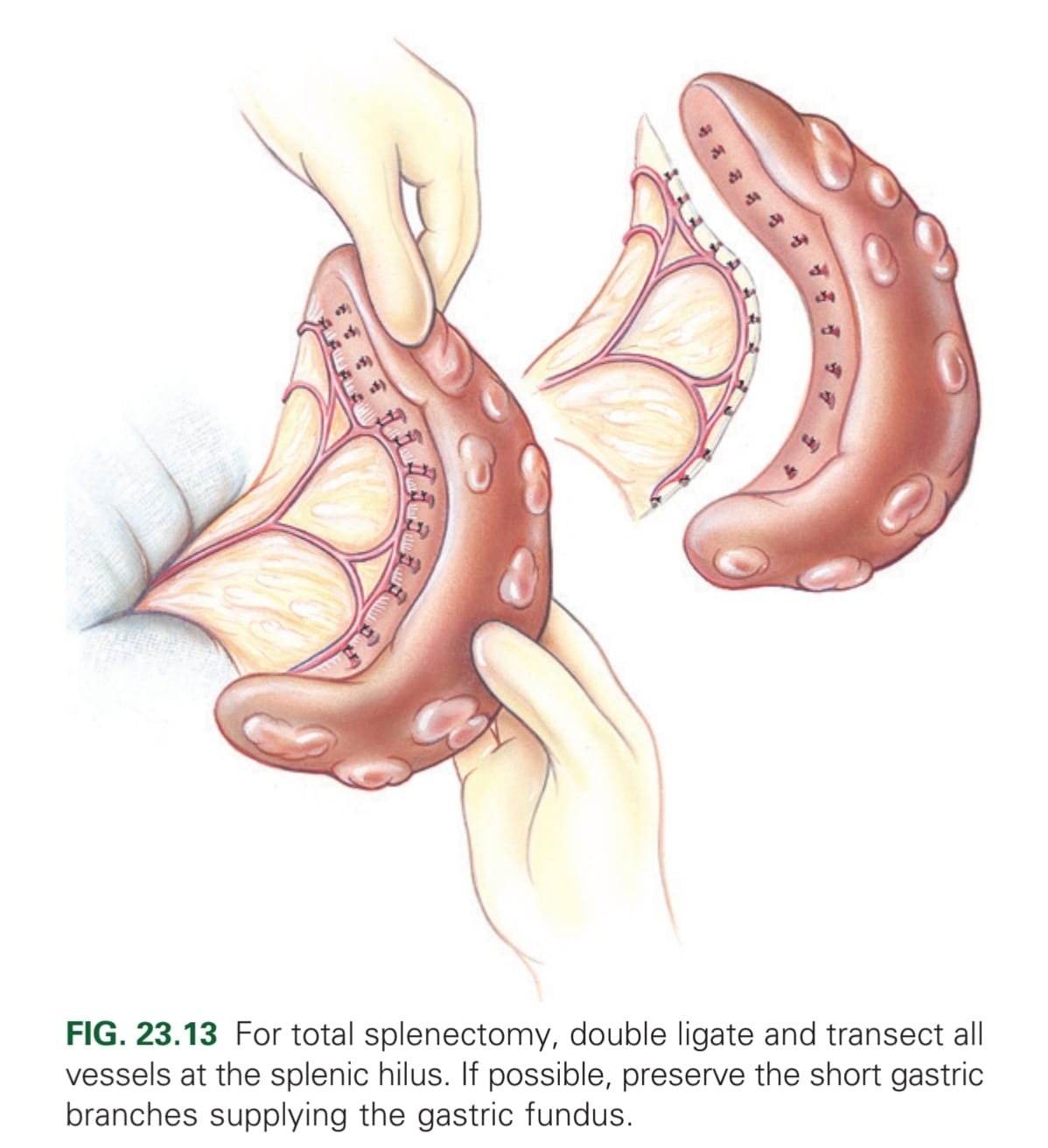 <p>Elevate by gentle manipulation out of abdomen → double ligation of each vessel that remains in abdomen (if possible, preserve the short gastric branches supplying the gastric fundus) → Resect spleen. If spleen has ruptured at the time of surgery, lavage the abdominal cavity to prevent neoplastic cells entering.</p>