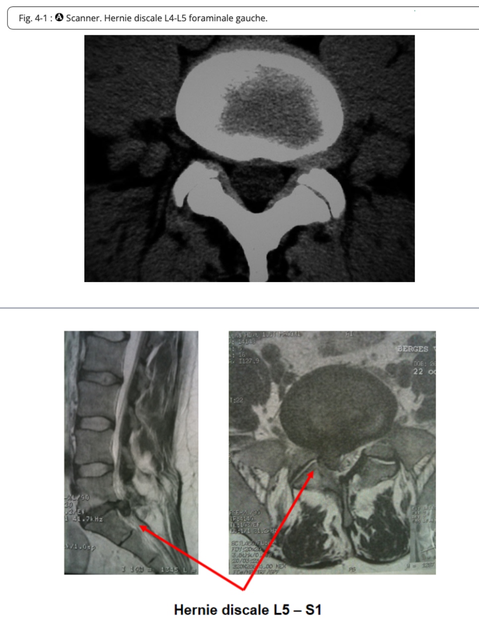 <p>=lésion atteignant le rachis et caractérisée par le déplacement d’une partie d’une disque intervertébral hors des limites de sa position initiale → ouverture de l’anneau fibreux laissant passer une partie du noyau pulpeux </p>