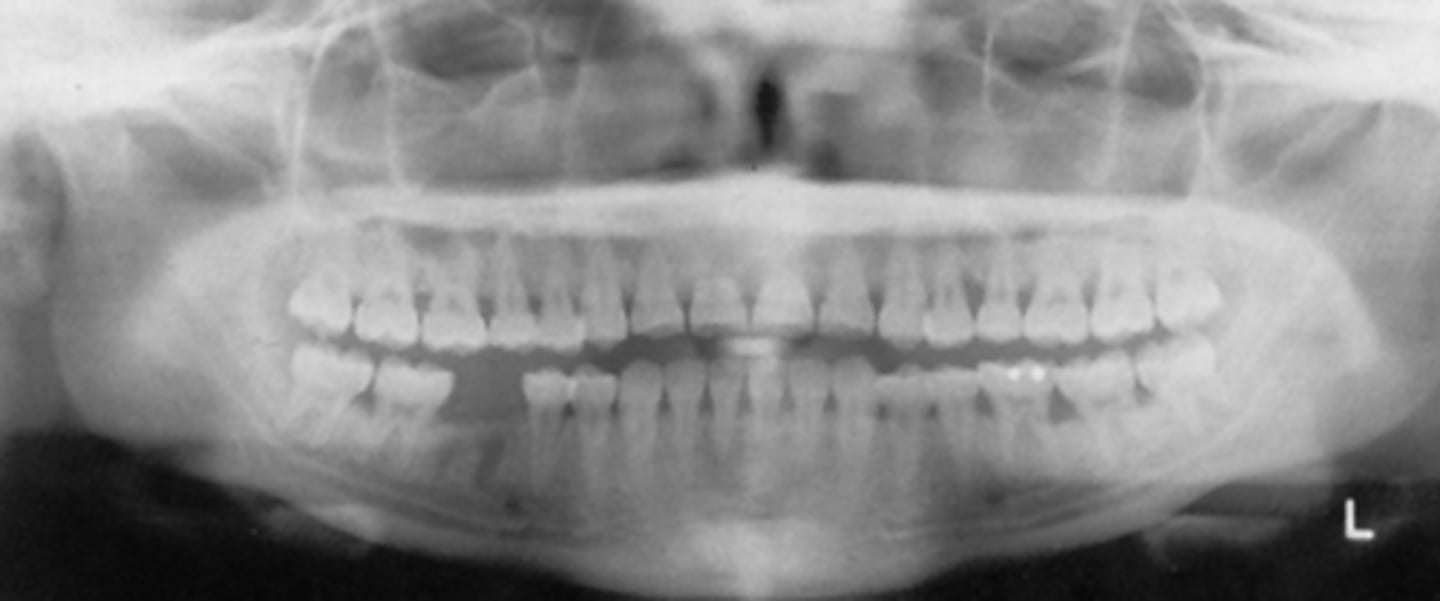 <p>What light needs to repositioned in order to gain the roots of the upper teeth?</p><p>A) mid-sagittal</p><p>B) Frankfort plane</p><p>C) focal trough</p>