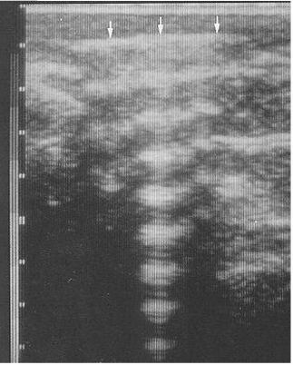 <p>Ultrasound waves hit objects and reflect back to the scanner head, these waves can then reflect off of the scanner head and then reflect off the tissue again, back to the scanner head. This leads to artefactual whitening in a linear pattern.</p>