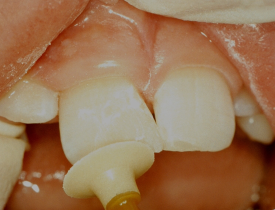 <p>restoration is polished using&nbsp;</p>