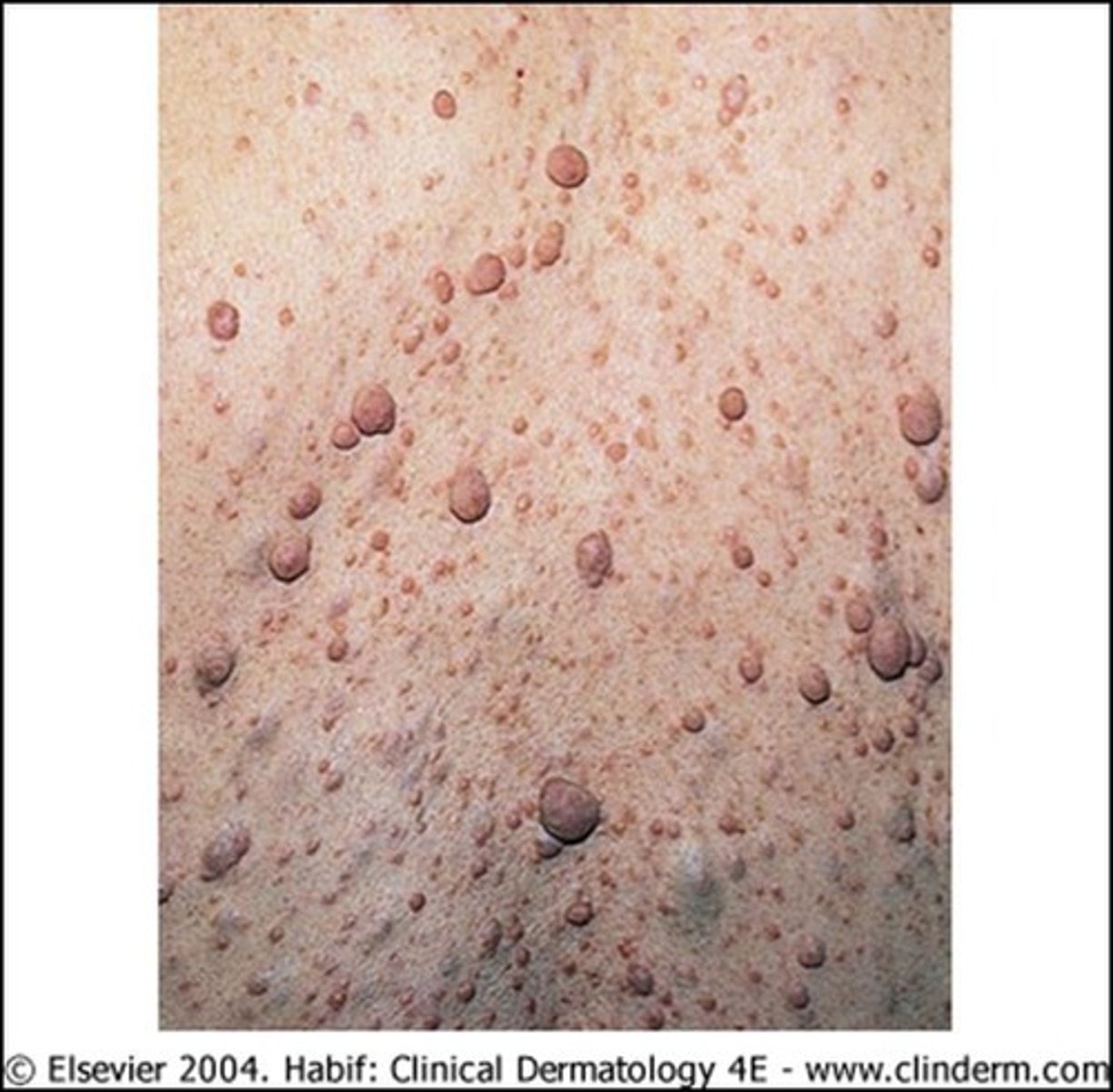 <p>-seen in patients with neurofibromatosis type 1</p><p>-S/S: typically mild; <span style="color: red;"><strong>soft, fleshy, sessile or pedunculated flesh-colored growths found along peripheral nerves under the skin or deeper inside body</strong></span></p>