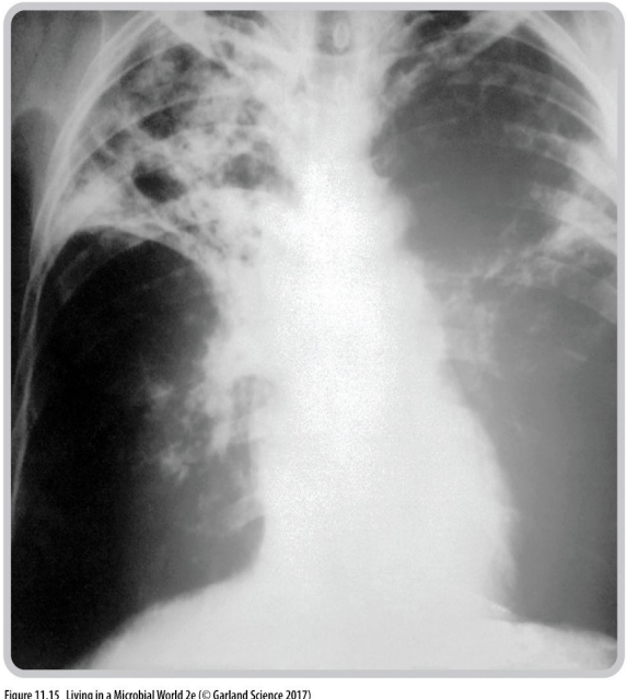 <p>The aim of the immune response is to resolve/clear the infection BUT</p>