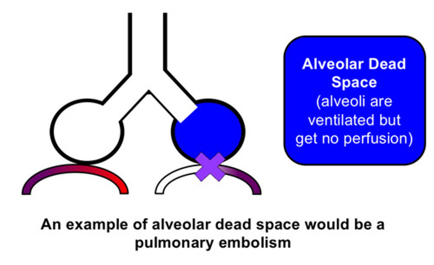 <p>areas of the respiratory zone (particularly the alveoli) that receive ventilation but for some PATHOLOGIC reason, do not receive any perfusion (ex: pulmonary embolism)</p>