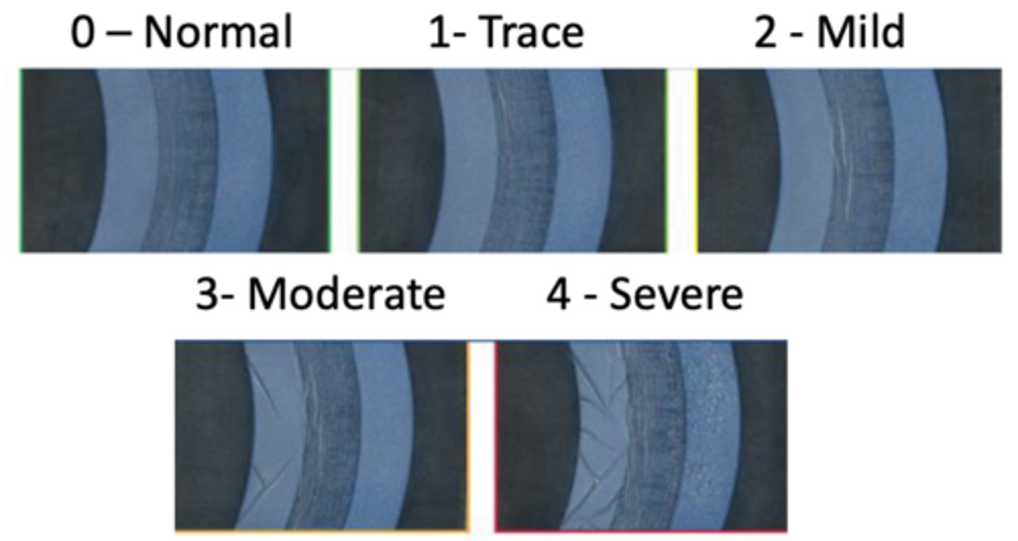 <p>What are some characteristics of corneal edema?</p>