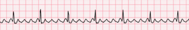 <p>Determine the atrial dysrhythmia:</p><p>Usually <strong>regular </strong>in nature compared to atrial fibrillation which has small S waves and is irregular; with big letter F waves that are in saw-like patterns; atrial rate varies between 250-350 bpm, most commonly 300.</p>