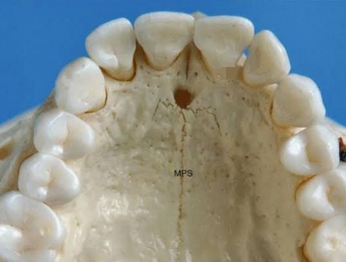 <ul><li><p>Located in anterior portion of hard palate</p></li><li><p>Location for anesthesia for anterior teeth</p></li></ul><p></p>