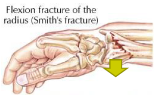 fall or blow to dorsal side of flexed wrist; distal fragment of wrist anteriorly displaced