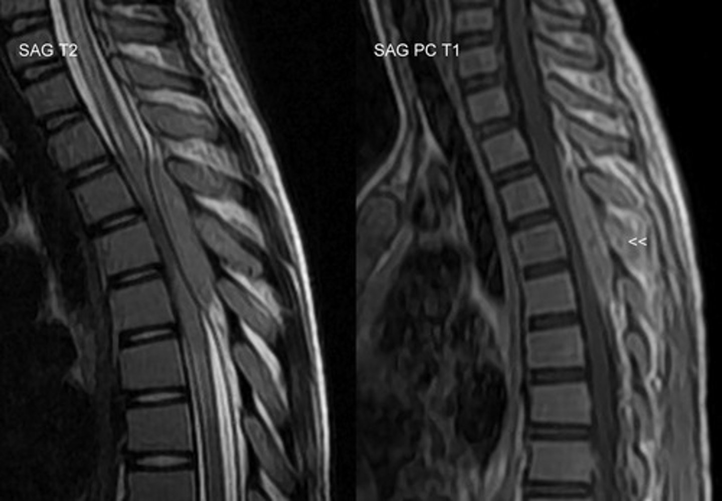 <p>spinal cord tumors that tend to be in the posterior regions of the spine due to ease of metastasizing near valveless blood vessels</p>