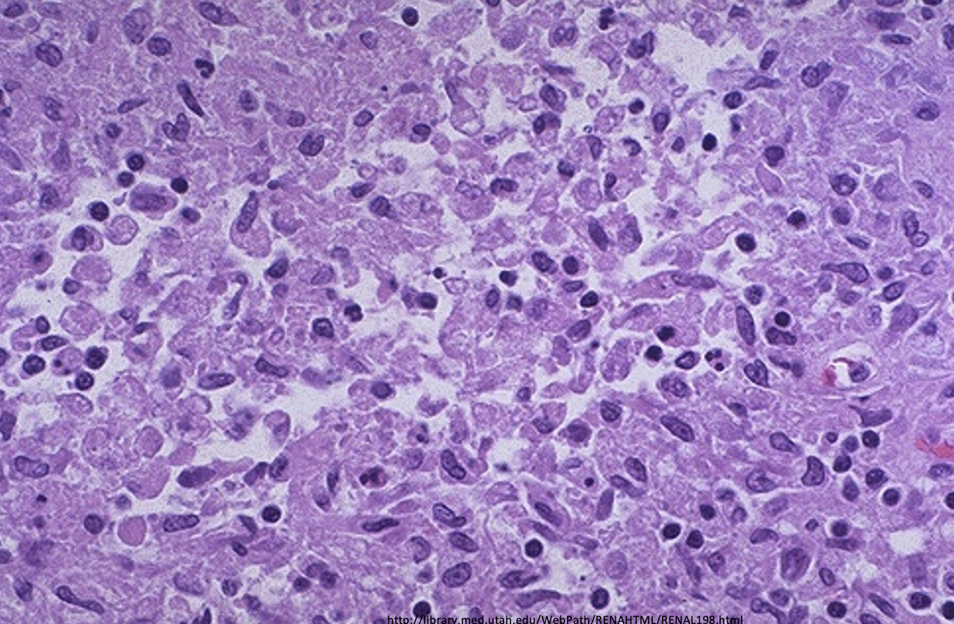 <p>What from this histology slides indicates a Xanthogranulomatous pyelonephritis?</p>