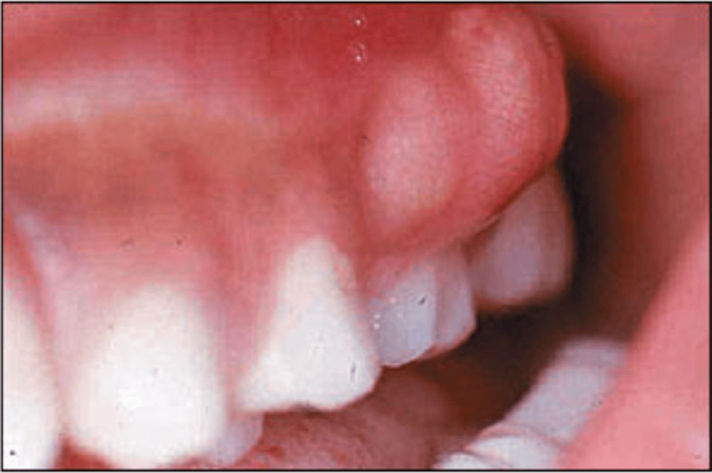 <p>dental abscess - pus in teeth or gums</p>