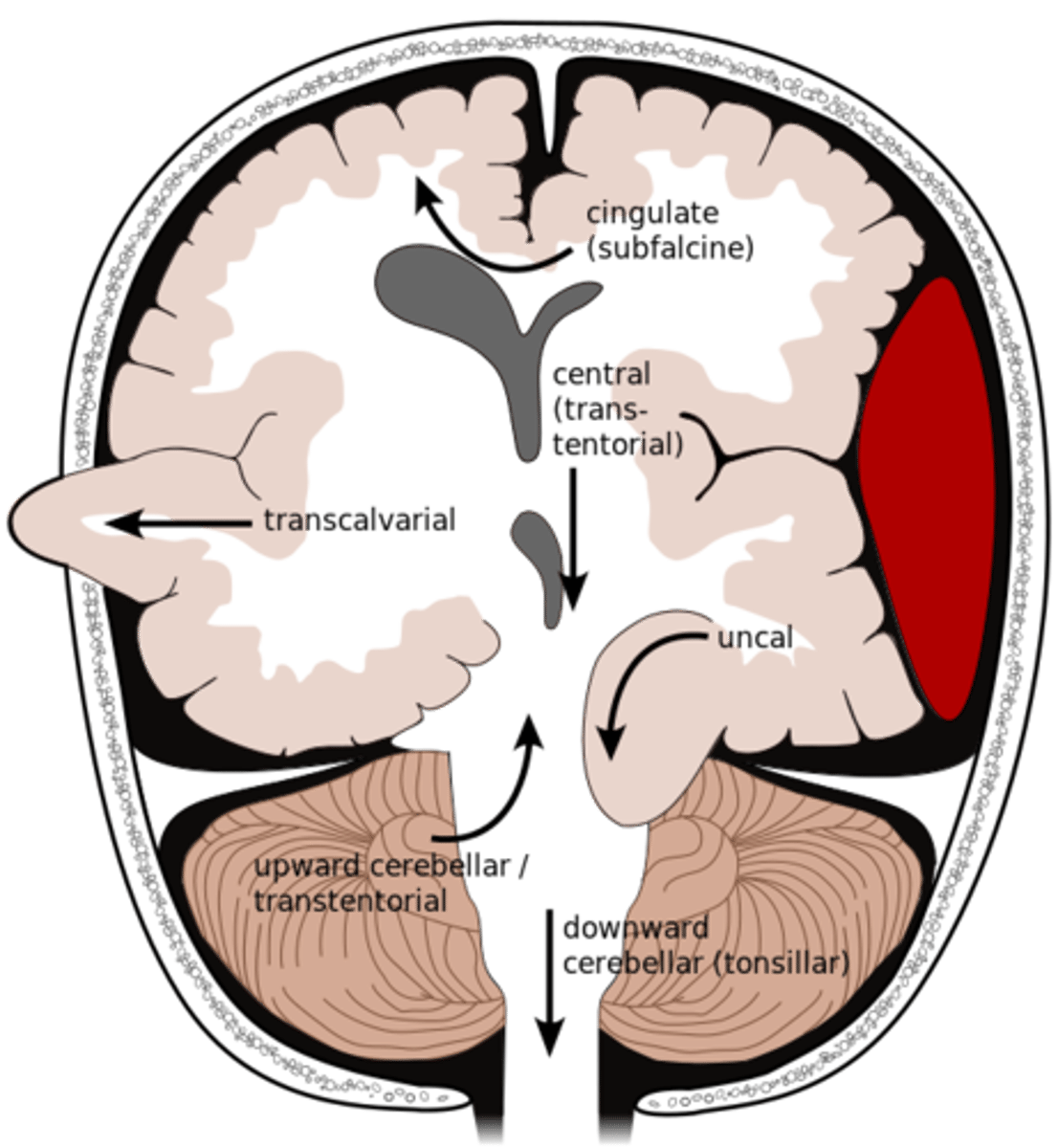 <p>brain begins to herniate outside of the skull. the brain will squeeze out of fractures, burr holes, or surgical incisions.</p>