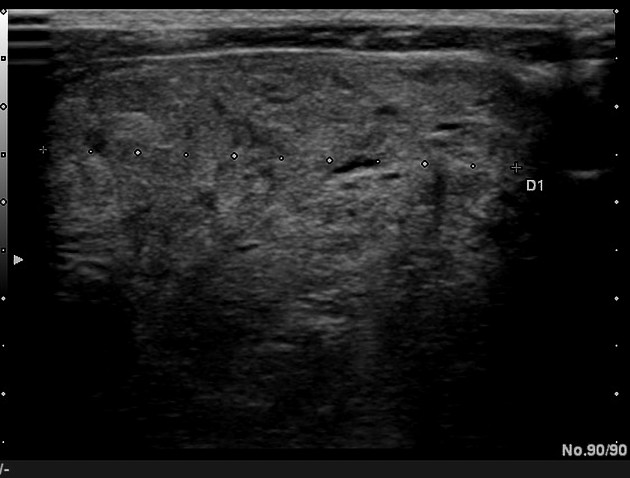 what thyroid pathology is shown here?