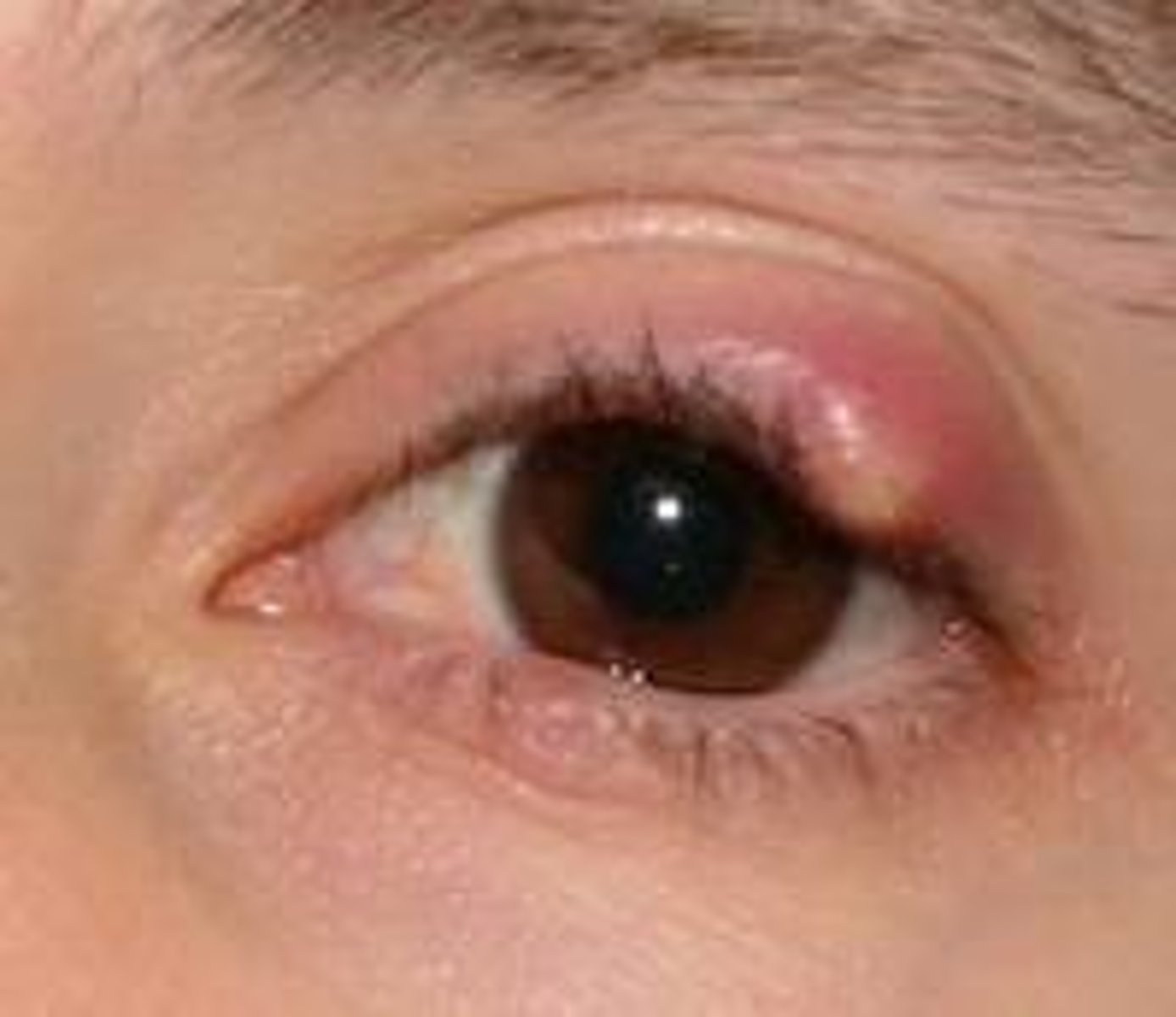 <p>Infection due to Staophylococcus aureus</p>