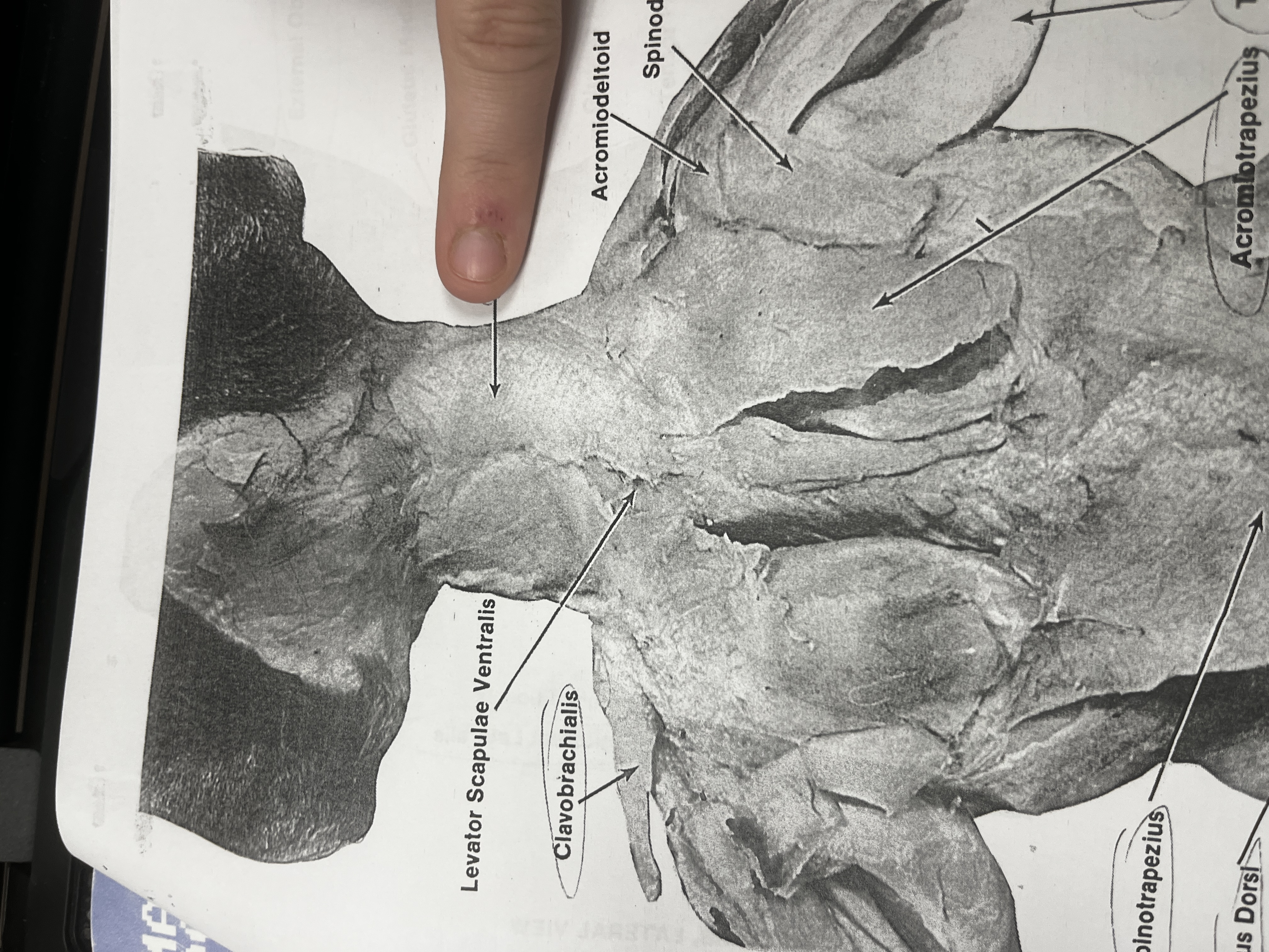 <p>A muscle in the shoulder that helps elevate the shoulder and retract the scapula.</p>