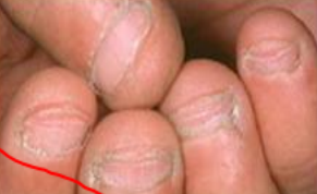 <p>the habit of compulsively biting one's nails. </p>