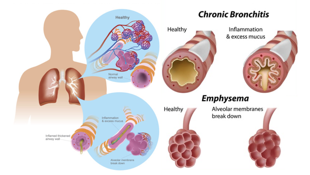 <p>Det är en tillstånd med kronisk obstruktivitet i luftvägarna. Vid sjukdomen har man vanligtvis <strong>emfysem</strong> OCH <strong>bronkiolit</strong> → inflammation som orsakar obstruktivitet på grund av tilltagande fibros och inflammatoriska celler såsom neutrofiler och makrofager.</p>