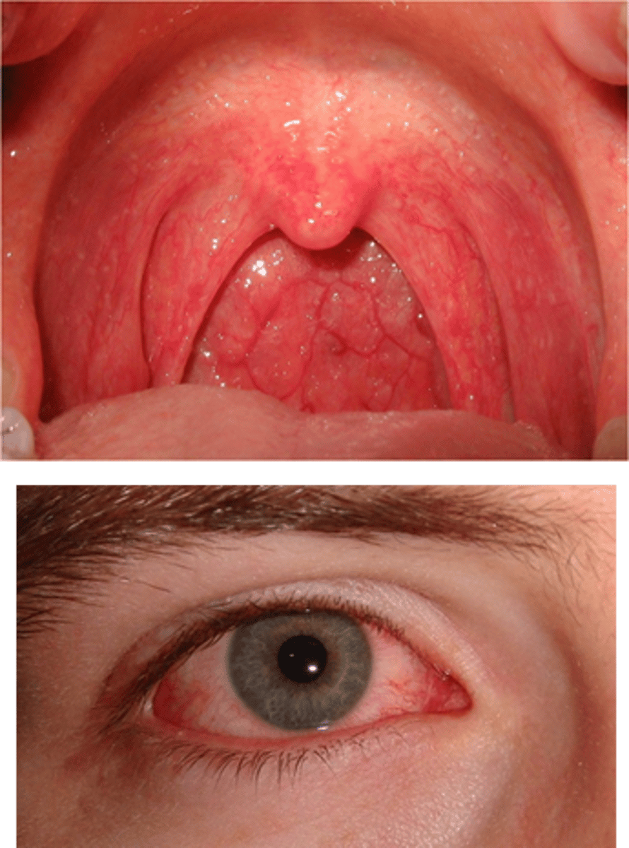 <p>serotypes 3 and 7; inflammation of both cornea and conjunctiva that is accompanied by pharyncojunctival fever</p>